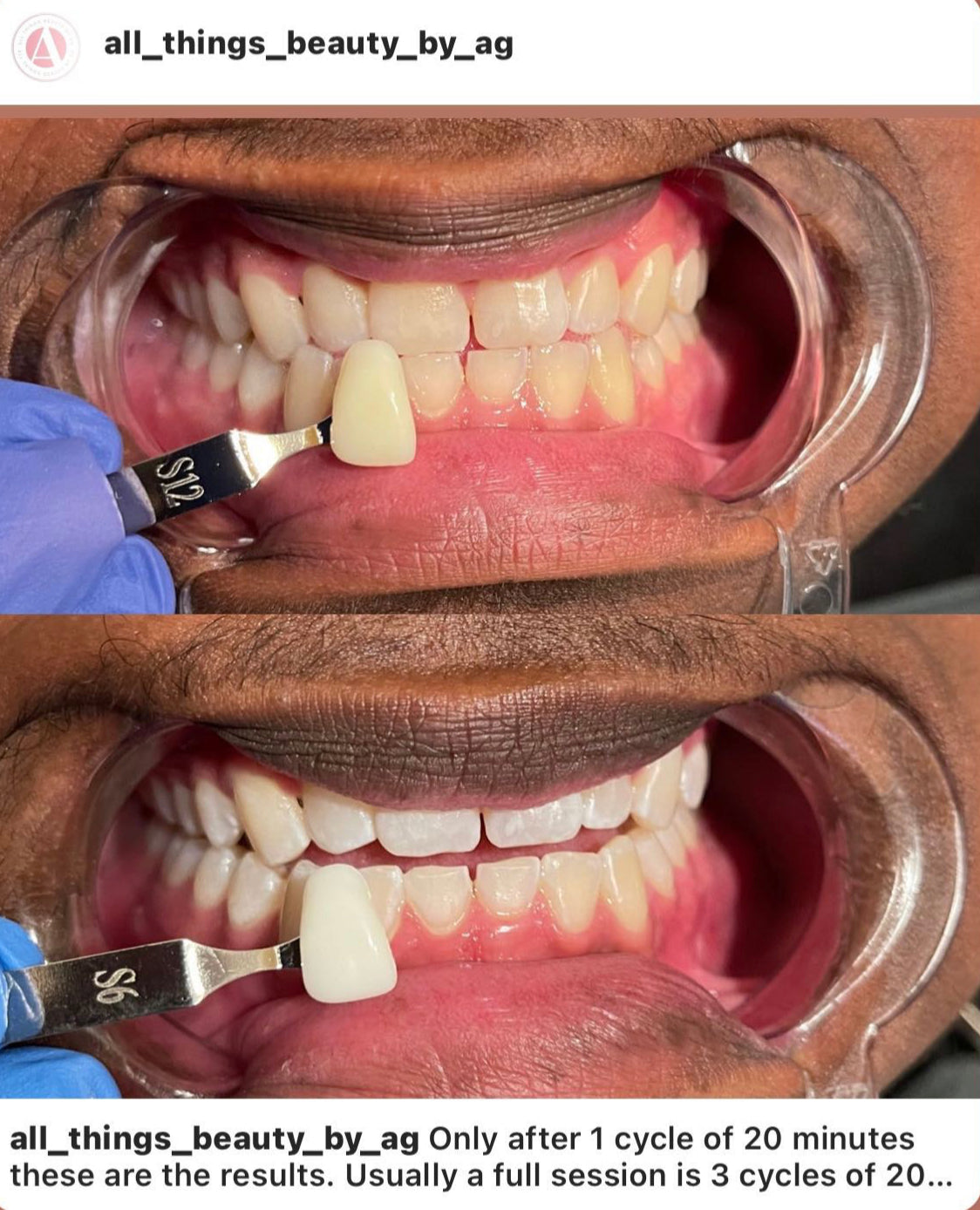 Professional Teeth Whitening Course + Kit