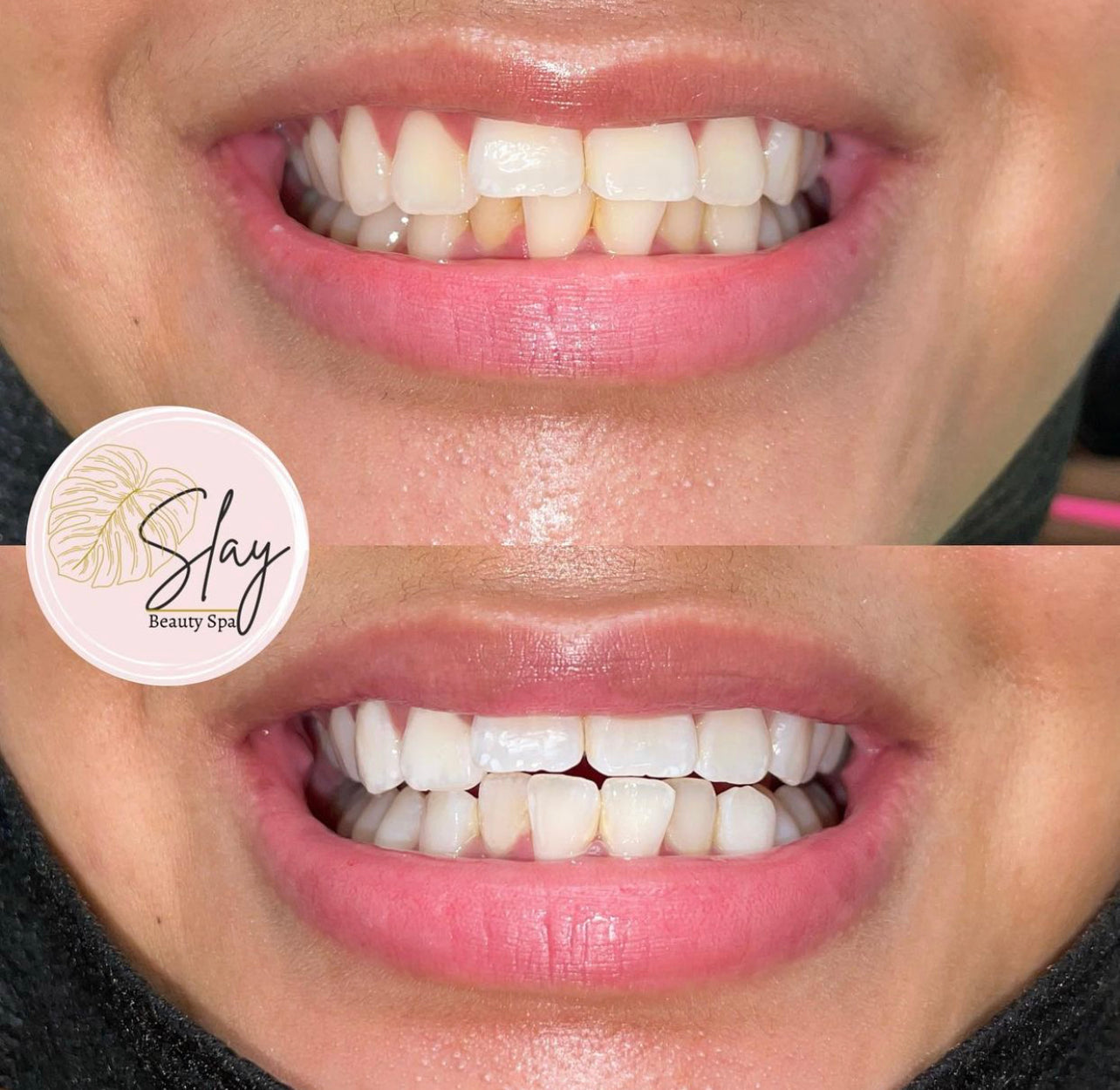 Professional Teeth Whitening Course