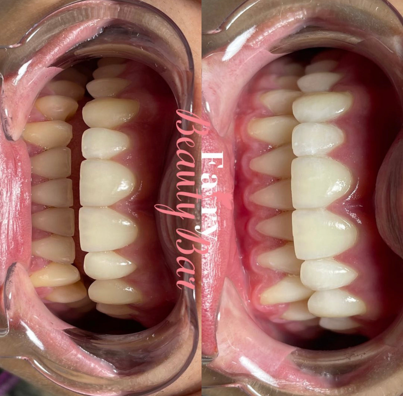 Professional Teeth Whitening Course